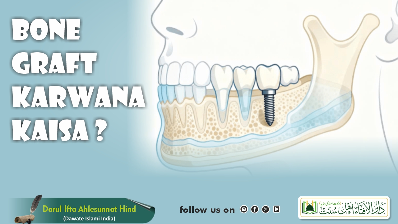 Bone Graft Karwana Kaisa ?